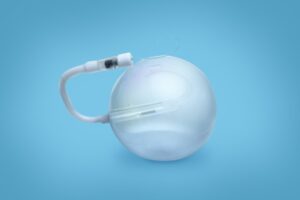 O balão intragástrico é um tratamento minimamente invasivo indicado para auxiliar no emagrecimento de forma segura e controlada. O procedimento é realizado por endoscopia, sem cortes, onde um balão de silicone é posicionado dentro do estômago e preenchido, ocupando parte do seu volume. Com isso, o paciente passa a sentir saciedade mais rapidamente, reduzindo a quantidade de alimentos ingeridos.