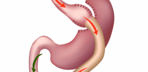 cirurgia bariatrica bypass