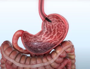 gastroplastia-endoscopica-angioskope2