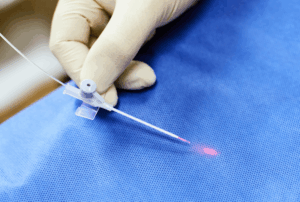 LASER ENDOVENOSO (EVLT) NO TRATAMENTO DE VARIZES