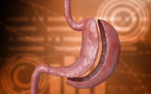 Clínica Angioskope 2 Bypass Gástrico é uma das técnicas de cirurgia bariátrica mais utilizadas no tratamento da obesidade. O procedimento combina a redução do tamanho do estômago com uma alteração no trajeto do intestino, permitindo não apenas uma menor ingestão de alimentos, mas também uma redução parcial da absorção de calorias. Essa combinação faz do Bypass uma das cirurgias mais eficazes para promover perda de peso significativa e melhora das doenças associadas à obesidade.