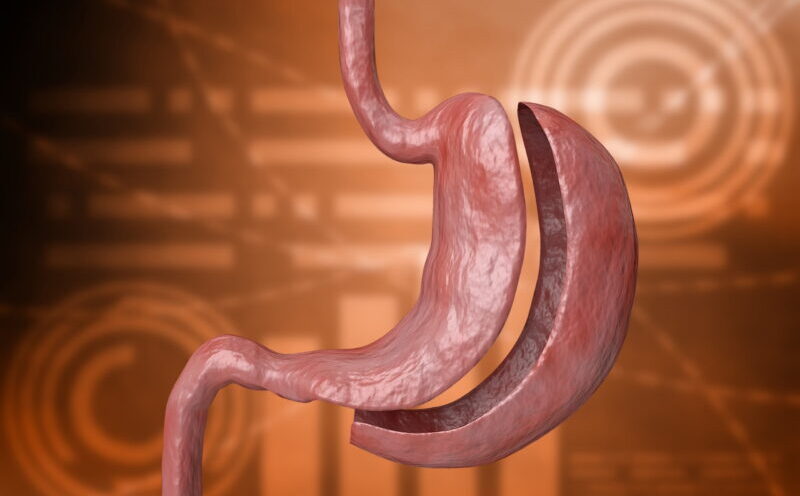 Bypass Gástrico é uma das técnicas de cirurgia bariátrica mais utilizadas no tratamento da obesidade. O procedimento combina a redução do tamanho do estômago com uma alteração no trajeto do intestino, permitindo não apenas uma menor ingestão de alimentos, mas também uma redução parcial da absorção de calorias. Essa combinação faz do Bypass uma das cirurgias mais eficazes para promover perda de peso significativa e melhora das doenças associadas à obesidade.