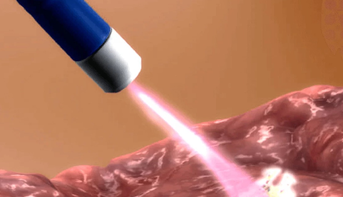 Plasma de Argônio: Uma Solução Eficaz para Pacientes que Fizeram Bypass Gástrico