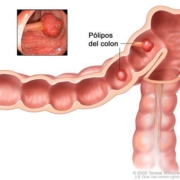 polipos do colon