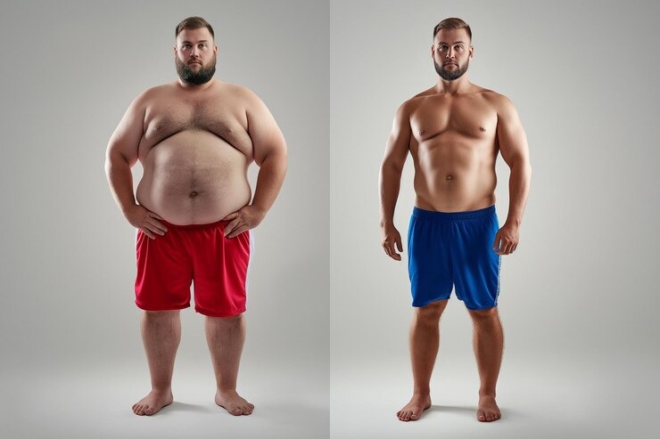 Obesidade 2