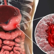 Úlcera Péptica de Estômago e Duodeno 82 image 10