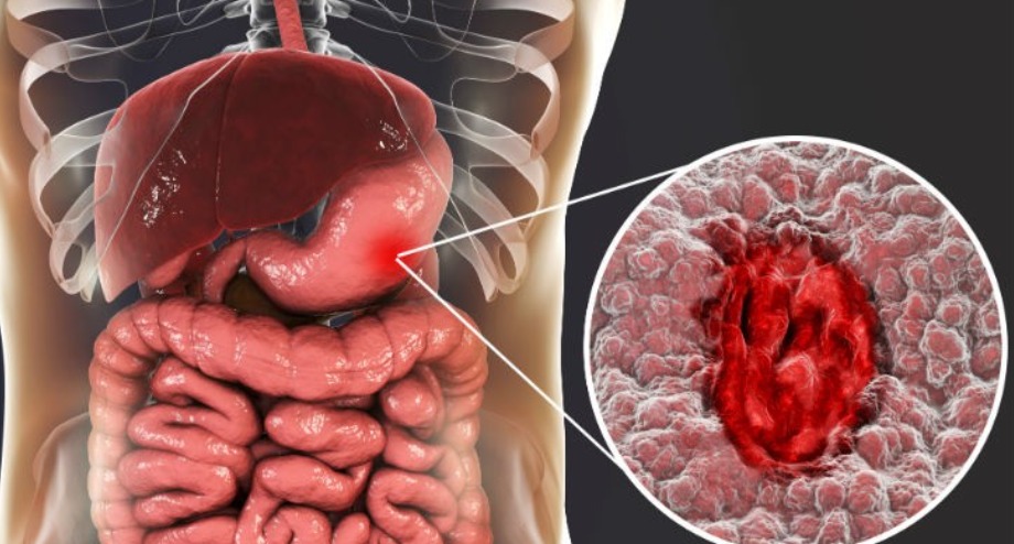 Úlcera Péptica de Estômago e Duodeno