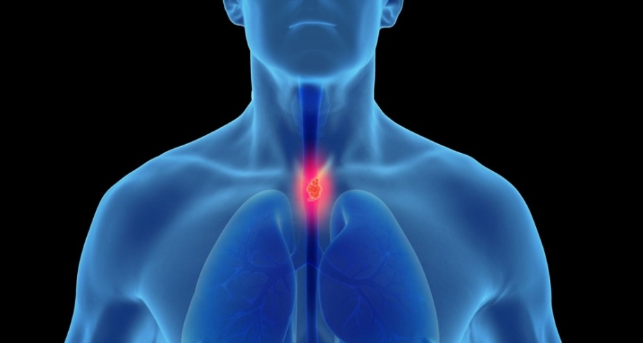 Notícias 246 Câncer de Esôfago