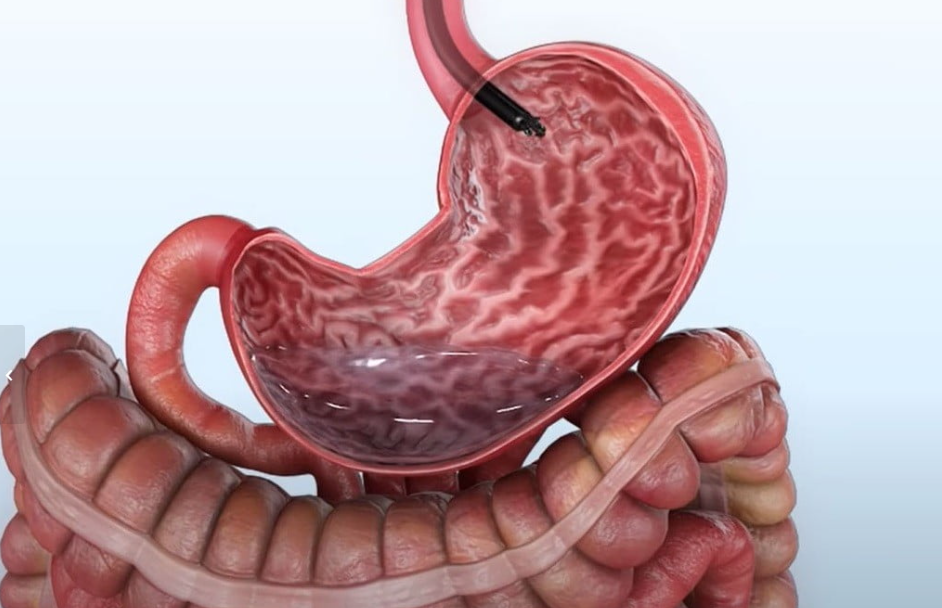 Como funciona o tratamento? O procedimento é realizado pela boca, com o auxílio de um endoscópio, permitindo que o médico faça pontos internos no estômago para diminuir sua capacidade. Dessa forma, o órgão passa a comportar menos alimento, contribuindo para o controle da fome e da ingestão alimentar. Por ser uma técnica sem cortes, a recuperação costuma ser mais rápida, com alta no mesmo dia na maioria dos casos. A gastroplastia também pode ser indicada em situações de reganho de peso, funcionando como uma alternativa revisional para pacientes que já passaram por cirurgia bariátrica. Os resultados variam de acordo com cada paciente, mas a perda média pode chegar a cerca de 20% do peso corporal, podendo ser superior em alguns casos. Para melhores resultados, o tratamento deve ser acompanhado por uma equipe multidisciplinar, incluindo orientação médica, nutricional e psicológica.